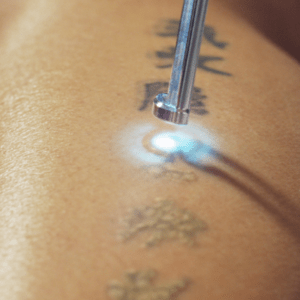 come togliere un tatuaggio