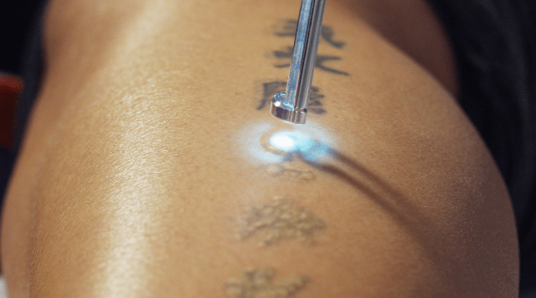 come togliere un tatuaggio